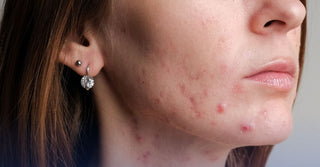 Acne: What helps to keep it under control